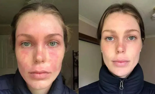 Say Goodbye to Eczema: The Power of Whipped Tallow Balm