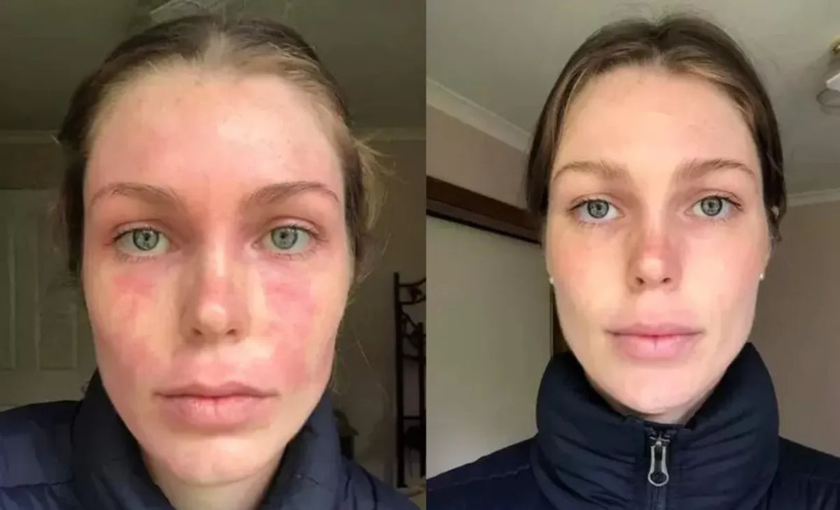 Say Goodbye to Eczema: The Power of Whipped Tallow Balm
